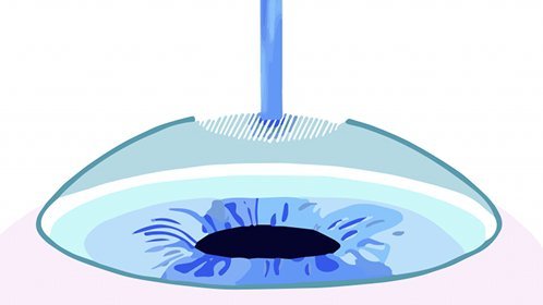 TransPRK flapless surface laser correction at The Vision Surgeon, Colchester.